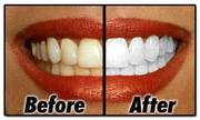 Limited Time Offer One Hour Teeth Whitening Service